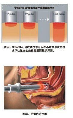 青春私密激光仪器展示