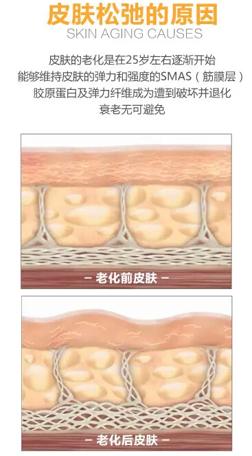 超声刀美容仪，带回童话般年纪